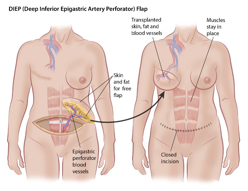 Breast reconstruction surgical planning